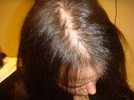 alopecia androgenetica femminile cure naturali