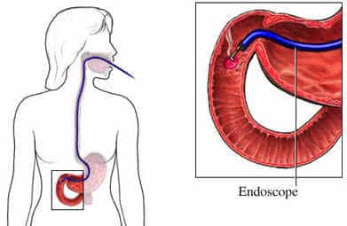 Gastroscopia endoscopica celiachia