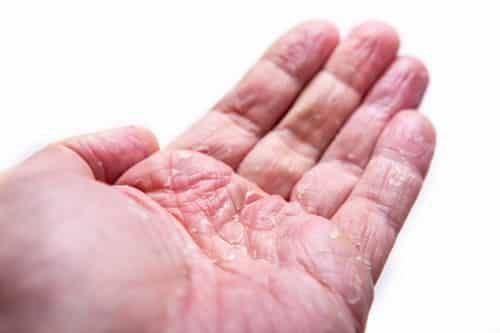 Eczema mani