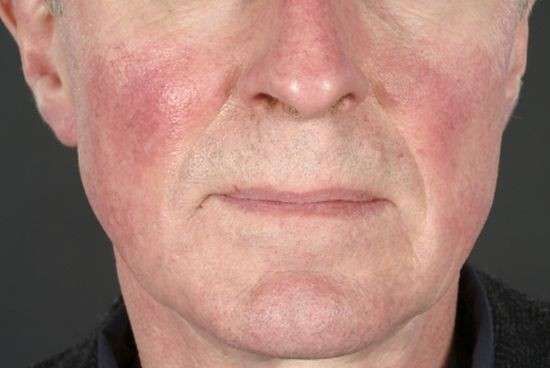 Rosacea